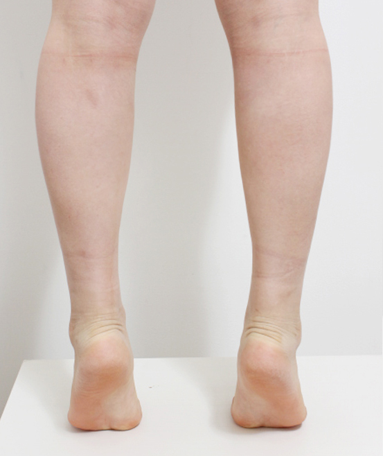 姜茹墨的整形术后图片