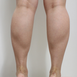 整形前后对比图片