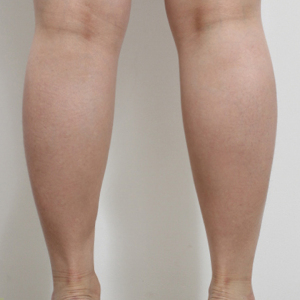 整形前后对比图片