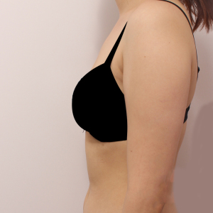 整形前后对比图片