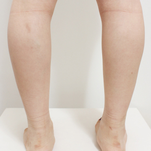 整形前后对比图片