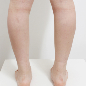 整形前后对比图片