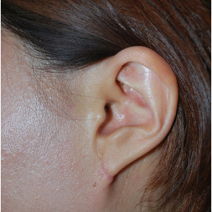 整形前后对比图片