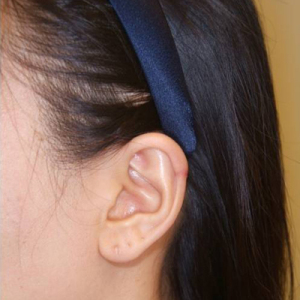 整形前后对比图片