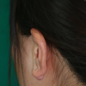 整形前后对比图片