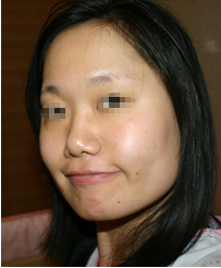 整形前后对比图片