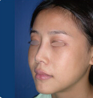 整形前后对比图片