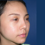 整形前后对比图片