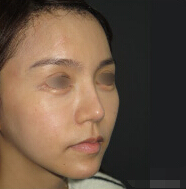 整形前后对比图片