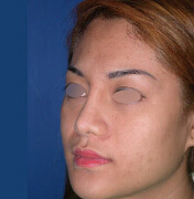 整形前后对比图片