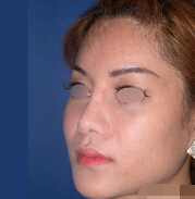 整形前后对比图片