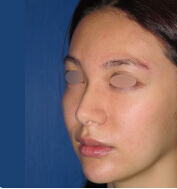 整形前后对比图片