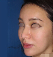 整形前后对比图片