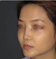 整形前后对比图片