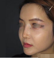 整形前后对比图片