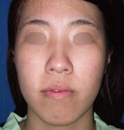 整形前后对比图片