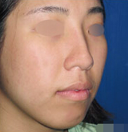 整形前后对比图片