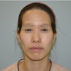 整形前后对比图片