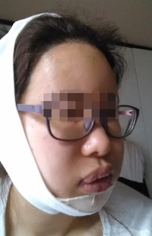 蔡垚垚的整形术后图片