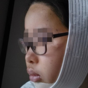 蔡垚垚的整形术后图片