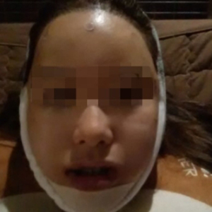 蔡垚垚的整形术后图片