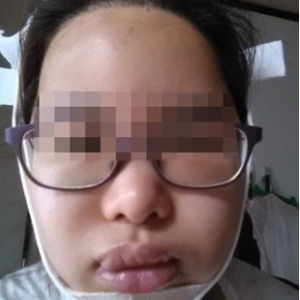 蔡垚垚的整形术后图片