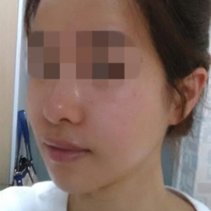 蔡垚垚的整形术后图片