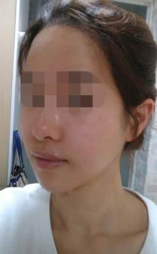 蔡垚垚的整形术后图片