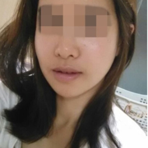 蔡垚垚的整形术后图片