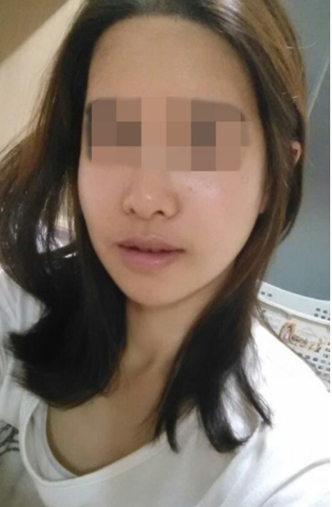 蔡垚垚的整形术后图片