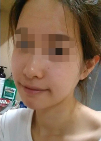 蔡垚垚的整形术后图片