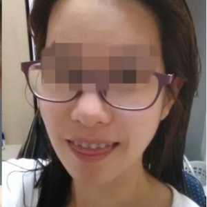 整形前后对比图片