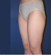 整形前后对比图片