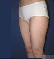 整形前后对比图片