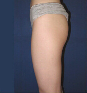 整形前后对比图片