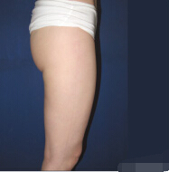 整形前后对比图片