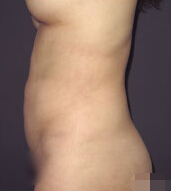 整形前后对比图片