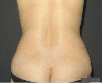 整形前后对比图片