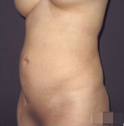 整形前后对比图片