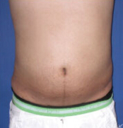 整形前后对比图片