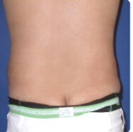 整形前后对比图片