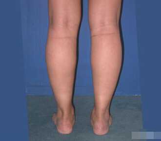 整形前后对比图片