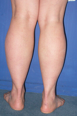 整形前后对比图片