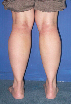 整形前后对比图片