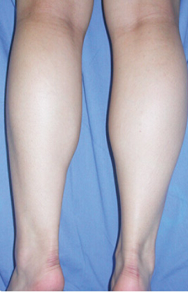 整形前后对比图片