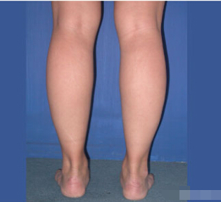 整形前后对比图片