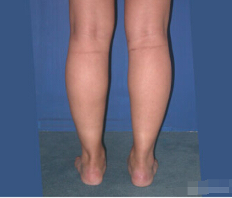 整形前后对比图片