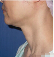 整形前后对比图片