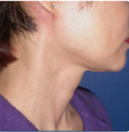 整形前后对比图片