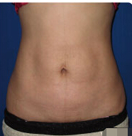 整形前后对比图片